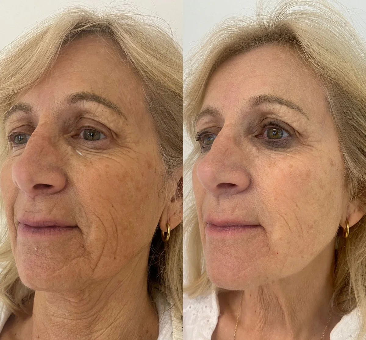 Before and after RF microneedling — a LUMOS Clinic client showing smoother skin texture and softer fine lines four weeks after one treatment